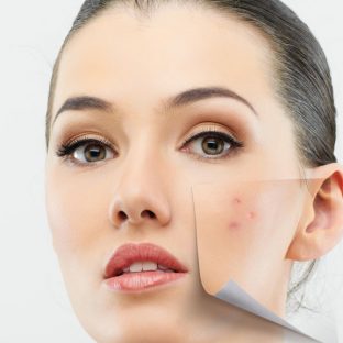 Quitar manchas faciales con láser