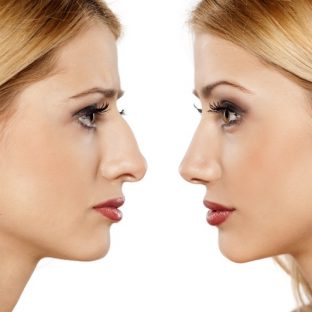 rinoplastia nariz grande